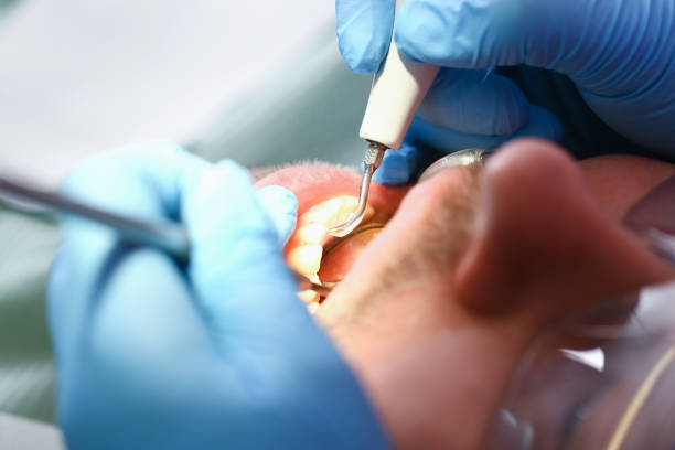 Best Emergency Treatment for Dental Infections or Abscesses in Wolf Creek, UT