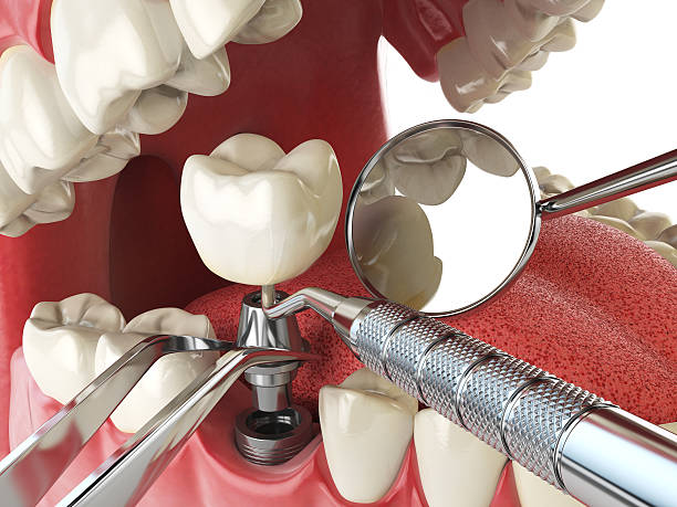 Best Emergency Dental Care for Broken or Chipped Teeth in Wolf Creek, UT